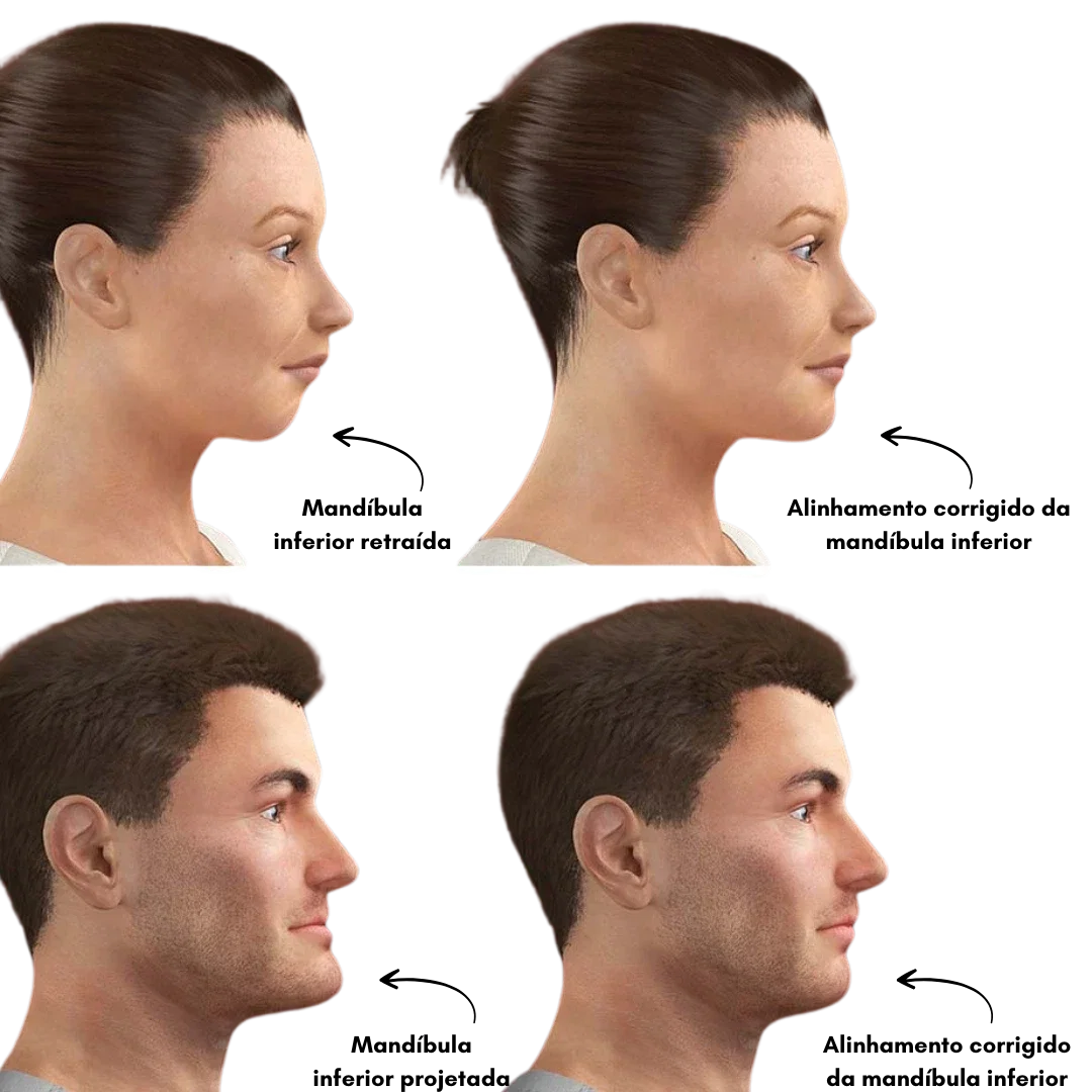 Comparativo antes e depois do alinhamento da mandíbula inferior, em perfil feminino e masculino