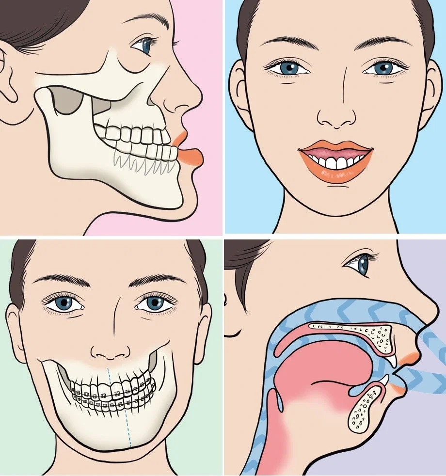 Ilustração em quatro painéis da cirurgia ortognática: estrutura óssea da face, sorriso alinhado, oclusão com aparelho e via aérea