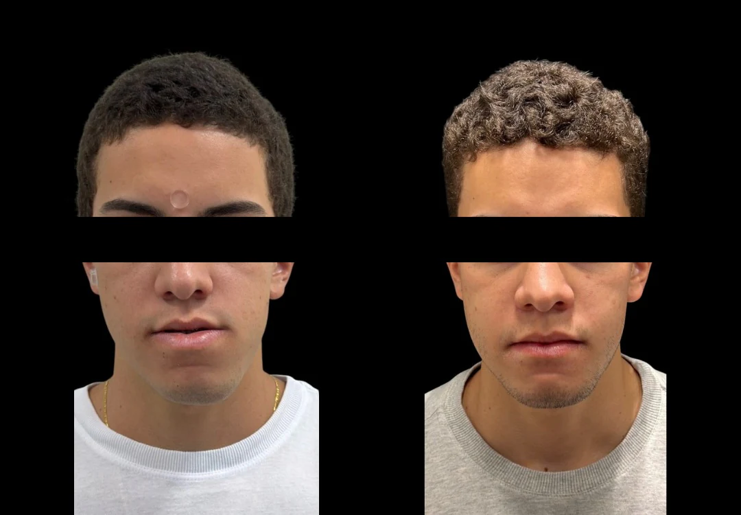 Duas fotografias de frente, lado a lado, do rosto de paciente em repouso, com os olhos cobertos por tarja