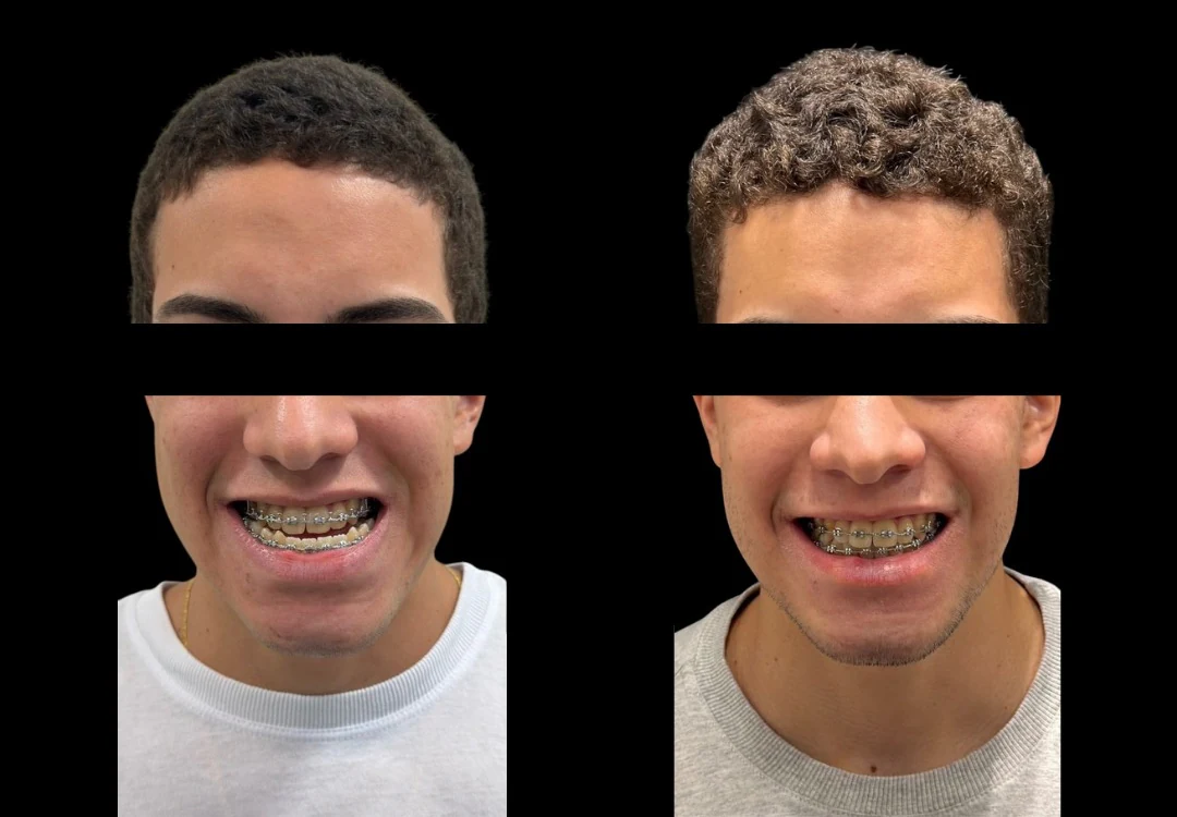 Duas fotografias de frente, lado a lado, de paciente sorrindo, com os olhos cobertos por tarja