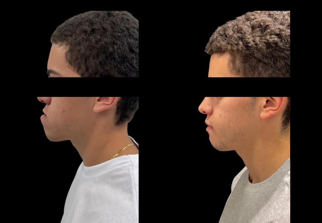 Duas fotografias de perfil, lado a lado, do rosto de paciente em repouso, com os olhos cobertos por tarja