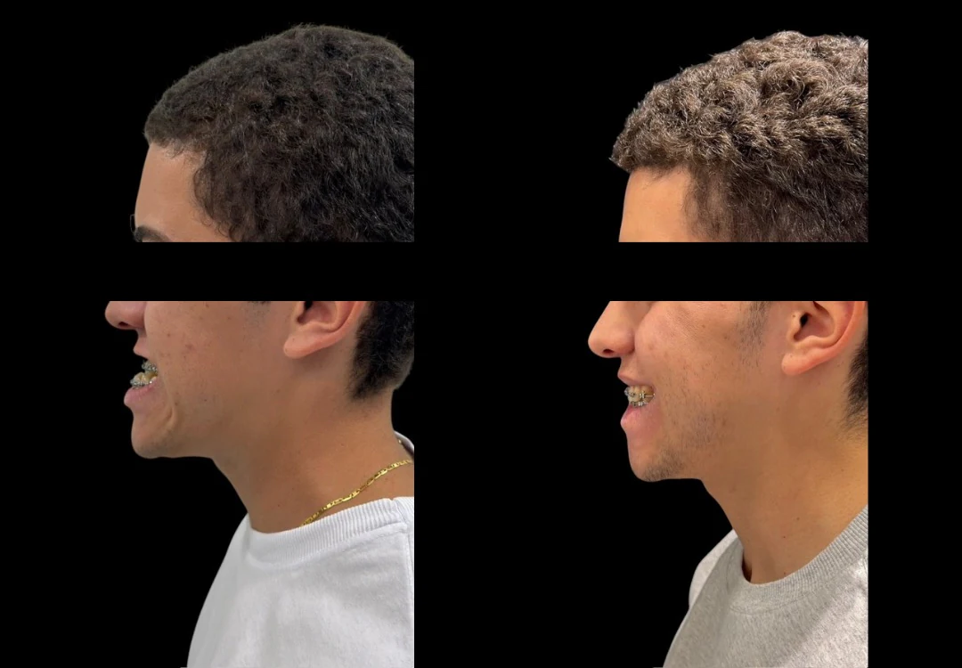 Duas fotografias de perfil, lado a lado, de paciente sorrindo, com os olhos cobertos por tarja
