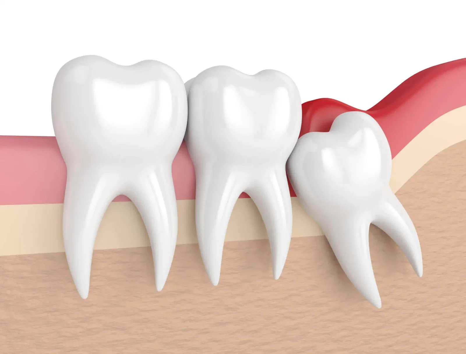 Ilustração 3D de um dente do siso incluso nascendo inclinado e pressionando os molares vizinhos